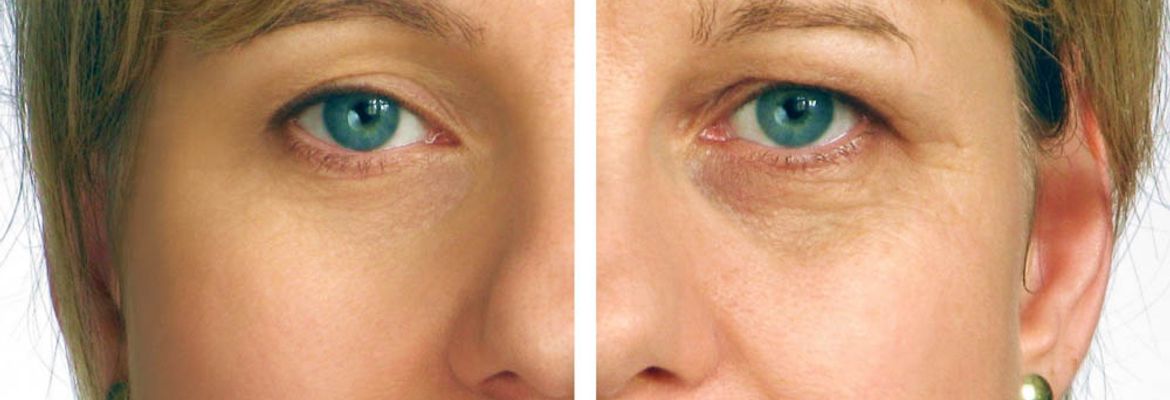 face lift before and after