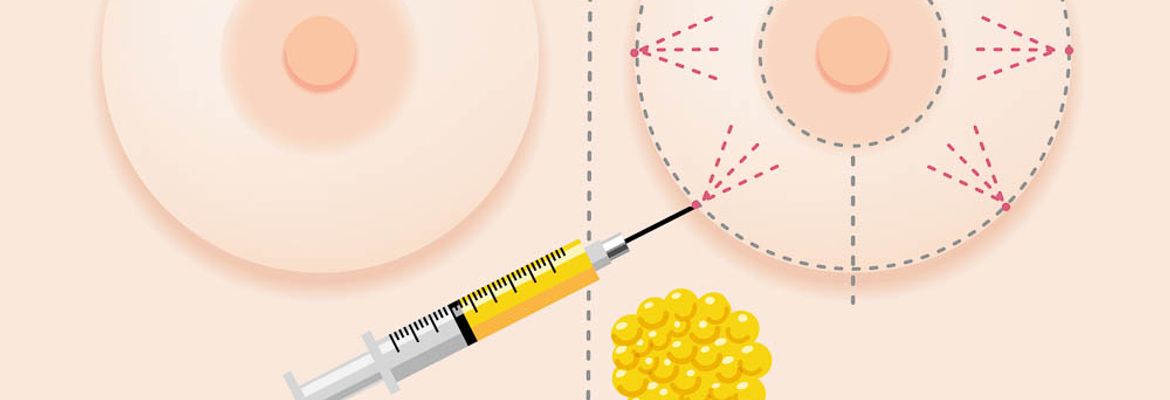 body fat transfers procedures done in costa rica