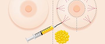 body-fat-transfers-procedures-done-in-costa-rica