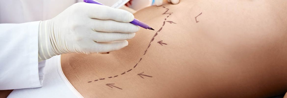 liposuction health procedure woman with lines in the stomach costa rica